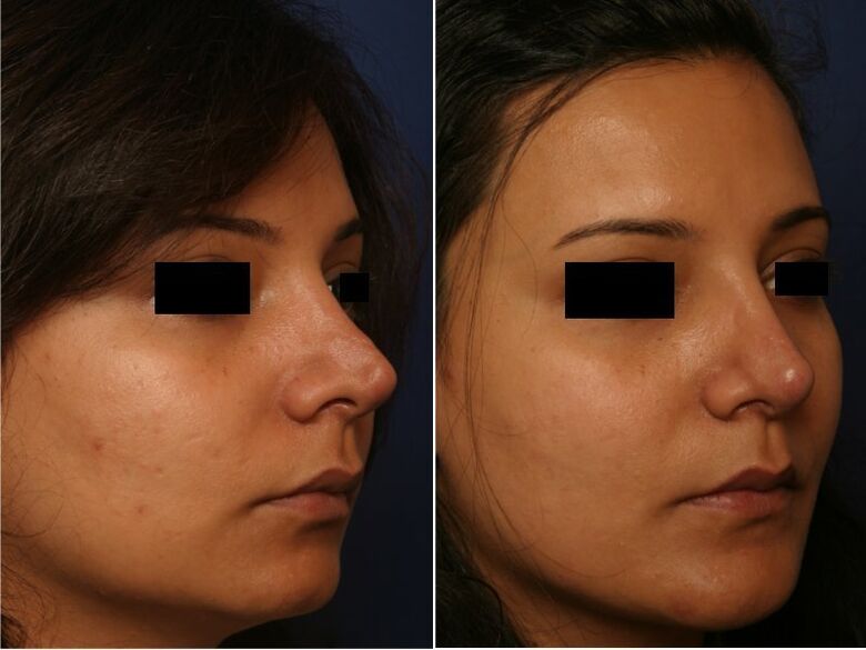 výsledok plastickej chirurgie