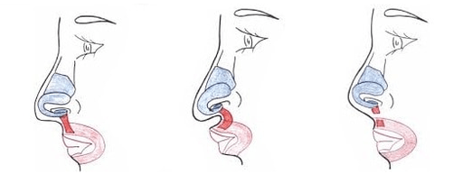 Skrátenie časti nosového svalu