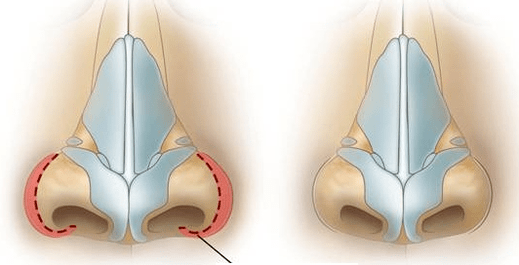 Zníženie nosných dierok