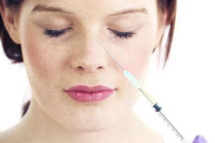 Nechirurgická rinoplastika s výplňami