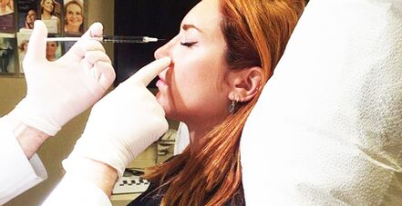 Postup rinoplastiky s použitím výplní