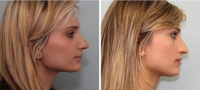 Výsledky rinoplastiky pred a po