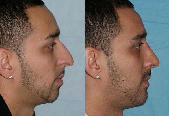 korekcia nosa pre mužov