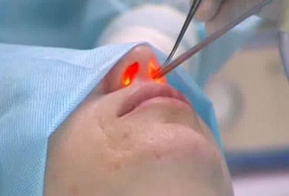 laserová rinoplastika nosa