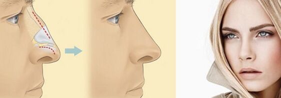 korekcia tvaru nosa nechirurgickou rinoplastikou
