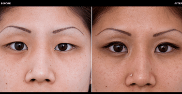 pred a po operácii očí