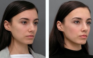 Dievča pred a po operácia očných viečok, nosa
