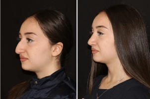 Výsledok vyrovnávaním nosa po operácia očných viečok