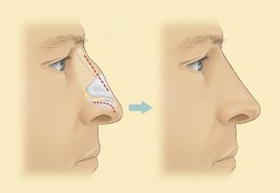 Ako je šetriace operácie očných viečok